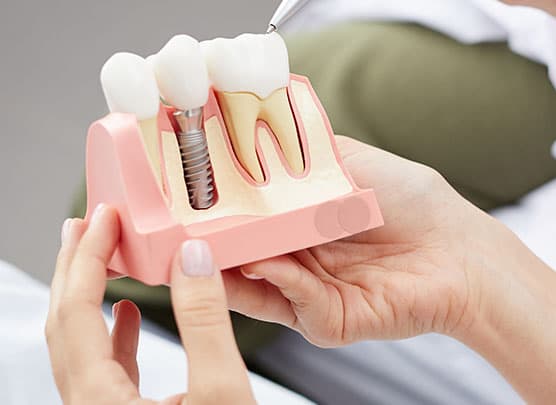 Dental Implants: What to Expect From Start to Finish